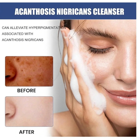 NWT Acne and Spots Cleansing Lotion Relief 50ml for Dry Skin Facial Cleanser - Picture 5 of 11